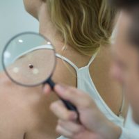 dermatologista-examinando-toupeira-com-lupa-1024x683-1-768x512