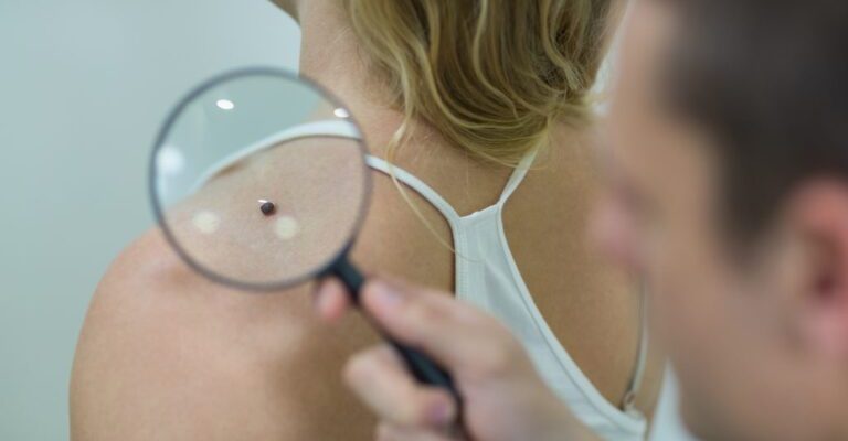 dermatologista-examinando-toupeira-com-lupa-1024x683-1-768x512